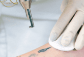 Dile adiós a los tatuajes no deseados y al vello no deseado en D’KAT Studio | Valle de los Chillos