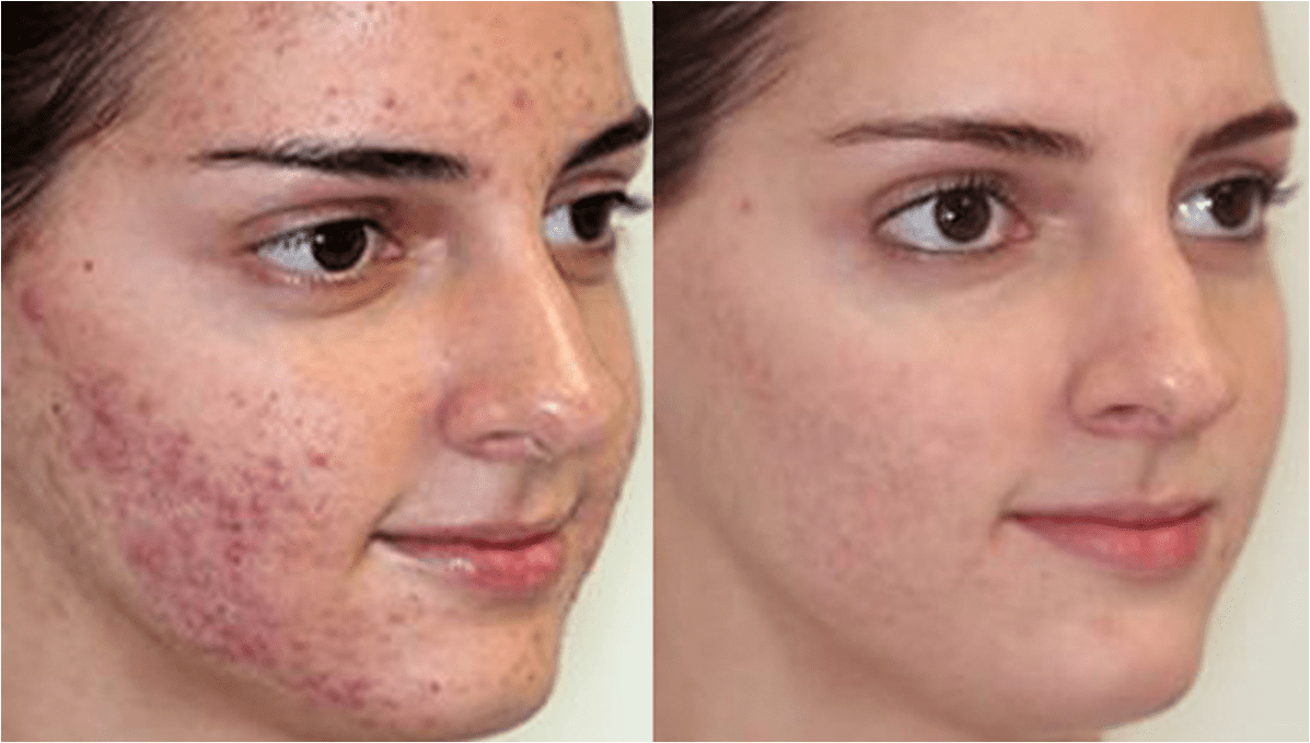 Tratamiento Anti-Acne en Guayaquil